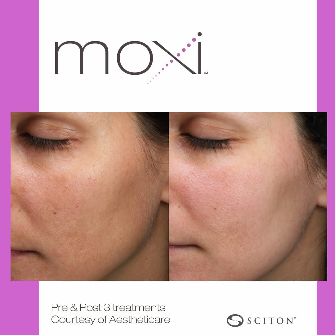 2-moxi-BA-1-