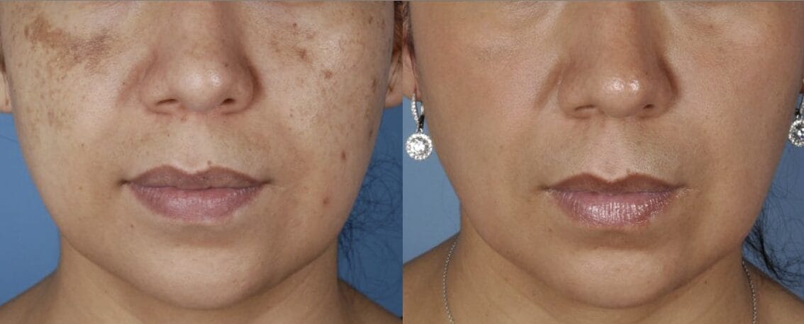 Close-up of a woman's face showing a before and after comparison; the left side reveals dark spots and uneven skin tone, while the right side shows clear, smooth, and even-toned skin.