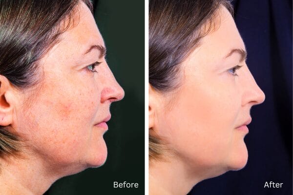 Side profile of a woman before and after a cosmetic procedure. The "before" image shows wrinkles and sagging skin, while the "after" image shows smoother and more youthful skin.